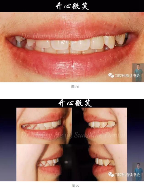 2017口腔醫(yī)師口腔組織病理之牙齦病 2017口腔醫(yī)師口腔組織病理之牙齦病