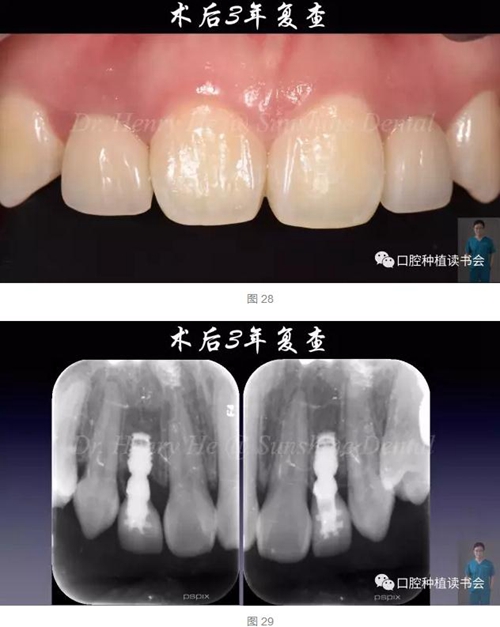 2017口腔醫(yī)師口腔組織病理之牙齦病 2017口腔醫(yī)師口腔組織病理之牙齦病