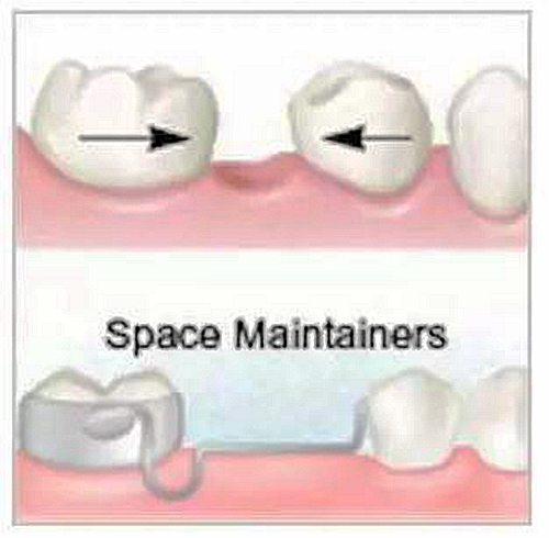 乳牙缺失致恒牙“亂長(zhǎng)”，這個(gè)“間隙保持器”可預(yù)防