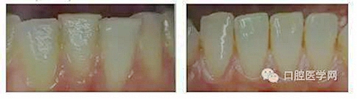 鄰面去釉的操作與注意事項(xiàng) 鄰面去釉的操作與注意事項(xiàng)