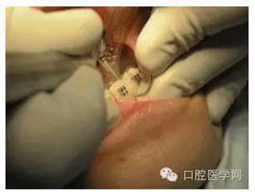 鄰面去釉的操作與注意事項(xiàng) 鄰面去釉的操作與注意事項(xiàng)