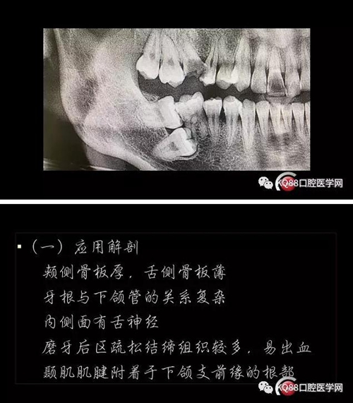 智齒拔除 智齒拔除