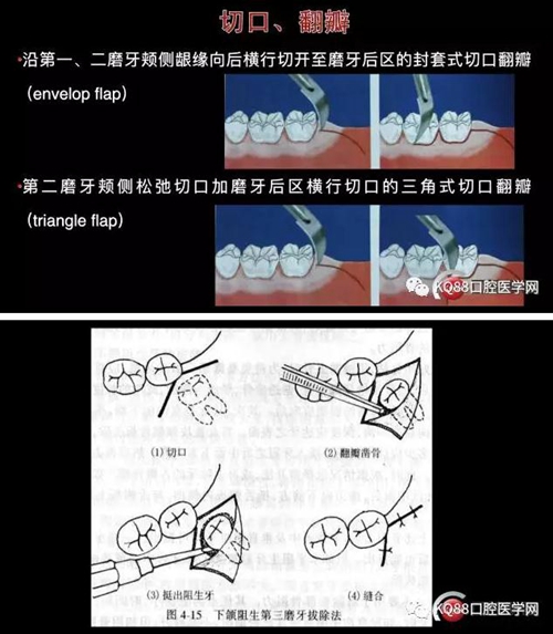 智齒拔除 智齒拔除