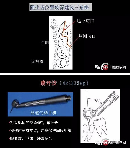 智齒拔除 智齒拔除