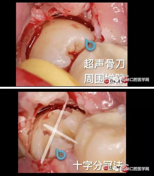 智齒拔除 智齒拔除