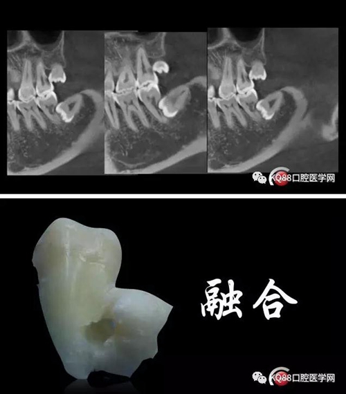 智齒拔除 智齒拔除