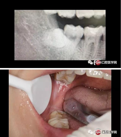 智齒拔除 智齒拔除