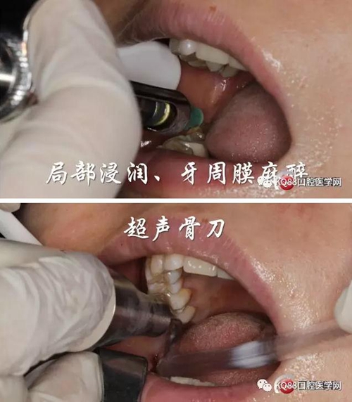 智齒拔除 智齒拔除