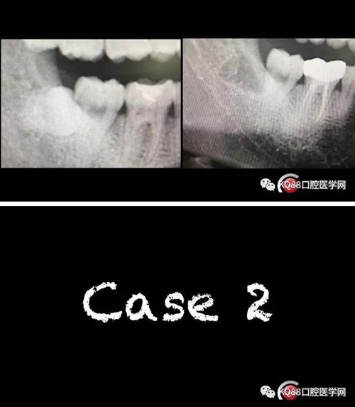 智齒拔除 智齒拔除