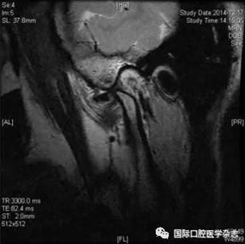 張清彬談張口受限 張清彬談張口受限