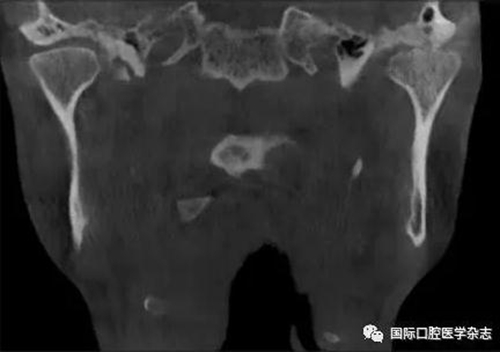 張清彬談張口受限 張清彬談張口受限
