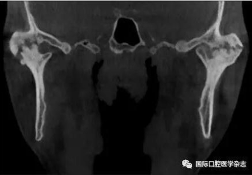 張清彬談張口受限 張清彬談張口受限