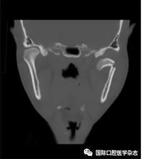 張清彬談張口受限 張清彬談張口受限