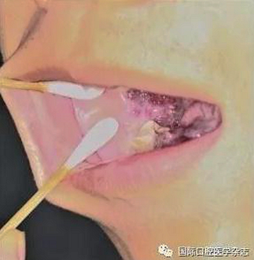 張清彬談張口受限 張清彬談張口受限