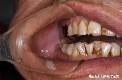 張清彬談張口受限 張清彬談張口受限