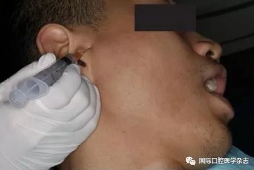 張清彬談張口受限 張清彬談張口受限