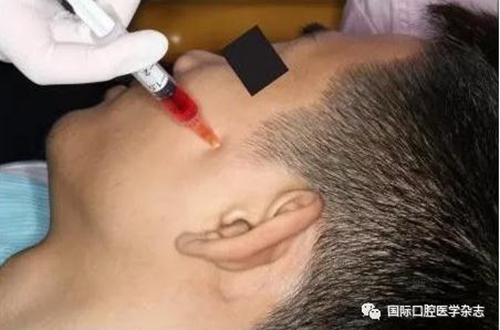 張清彬談張口受限 張清彬談張口受限