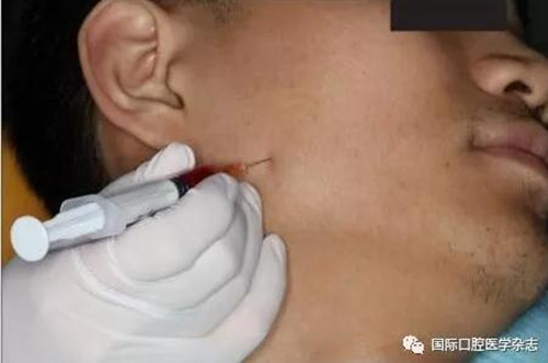 張清彬談張口受限 張清彬談張口受限