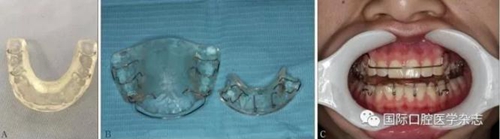 張清彬談張口受限 張清彬談張口受限