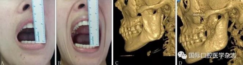 張清彬談張口受限 張清彬談張口受限