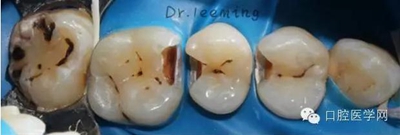 牙齒修復 牙齒修復