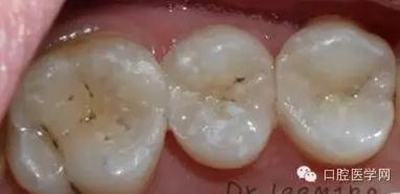 牙齒修復 牙齒修復