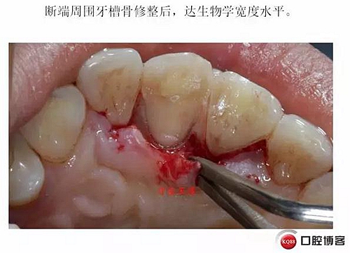 前牙外傷冠延長(zhǎng)+全瓷冠修復(fù) 前牙外傷冠延長(zhǎng)+全瓷冠修復(fù)