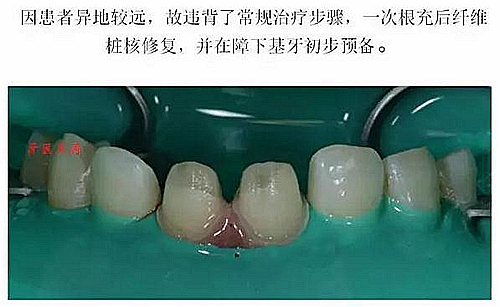 前牙外傷冠延長(zhǎng)+全瓷冠修復(fù) 前牙外傷冠延長(zhǎng)+全瓷冠修復(fù)