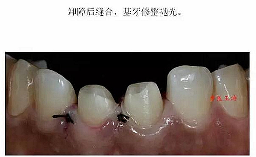 前牙外傷冠延長(zhǎng)+全瓷冠修復(fù) 前牙外傷冠延長(zhǎng)+全瓷冠修復(fù)