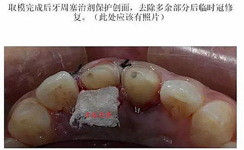 前牙外傷冠延長(zhǎng)+全瓷冠修復(fù) 前牙外傷冠延長(zhǎng)+全瓷冠修復(fù)