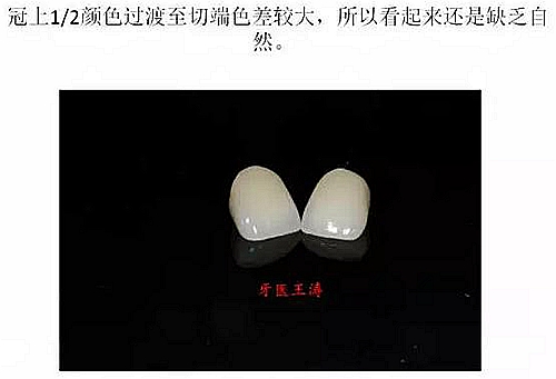 前牙外傷冠延長(zhǎng)+全瓷冠修復(fù) 前牙外傷冠延長(zhǎng)+全瓷冠修復(fù)