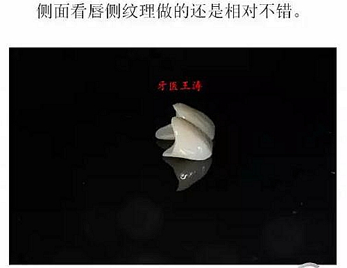 前牙外傷冠延長(zhǎng)+全瓷冠修復(fù) 前牙外傷冠延長(zhǎng)+全瓷冠修復(fù)