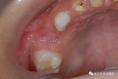 【牙醫(yī)學(xué)堂】間隙保持器的介紹 【牙醫(yī)學(xué)堂】間隙保持器的介紹