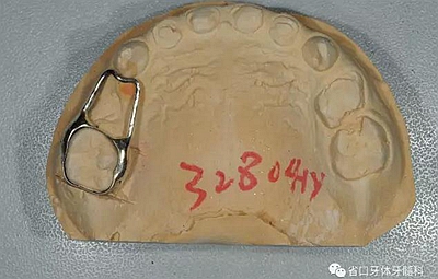 【牙醫(yī)學(xué)堂】間隙保持器的介紹 【牙醫(yī)學(xué)堂】間隙保持器的介紹