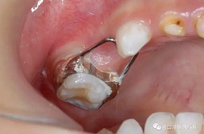 【牙醫(yī)學(xué)堂】間隙保持器的介紹 【牙醫(yī)學(xué)堂】間隙保持器的介紹