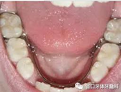 【牙醫(yī)學(xué)堂】間隙保持器的介紹 【牙醫(yī)學(xué)堂】間隙保持器的介紹
