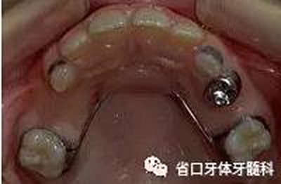 【牙醫(yī)學(xué)堂】間隙保持器的介紹 【牙醫(yī)學(xué)堂】間隙保持器的介紹