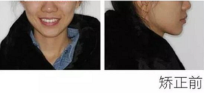 醫(yī)生方案里的鄰面去釉，究竟是什么？