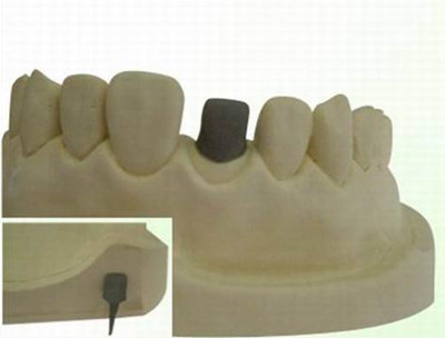 美國CBD纖維樁簡介及纖維樁臨床操作步驟及樁核的若干問題 美國CBD纖維樁簡介及纖維樁臨床操作步驟及樁核的若干問題
