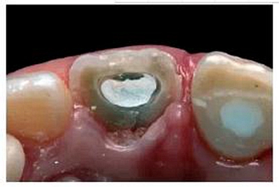 牙體大面積缺損:根管治療后行纖維樁—樹脂修復 牙體大面積缺損:根管治療后行纖維樁—樹脂修復