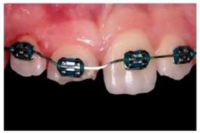 牙體大面積缺損:根管治療后行纖維樁—樹脂修復 牙體大面積缺損:根管治療后行纖維樁—樹脂修復