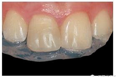 牙體大面積缺損:根管治療后行纖維樁—樹脂修復 牙體大面積缺損:根管治療后行纖維樁—樹脂修復