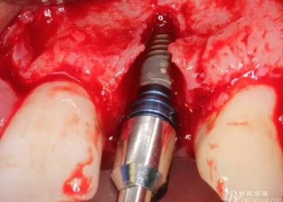 一例上前牙種植失敗病例的補(bǔ)救 一例上前牙種植失敗病例的補(bǔ)救