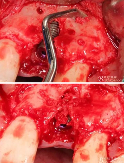 一例上前牙種植失敗病例的補(bǔ)救 一例上前牙種植失敗病例的補(bǔ)救