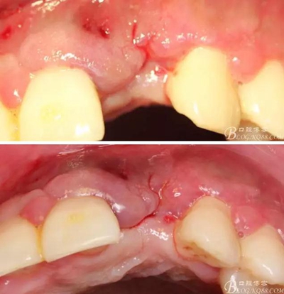 一例上前牙種植失敗病例的補(bǔ)救 一例上前牙種植失敗病例的補(bǔ)救