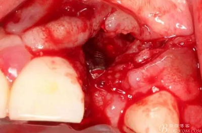 一例上前牙種植失敗病例的補(bǔ)救 一例上前牙種植失敗病例的補(bǔ)救