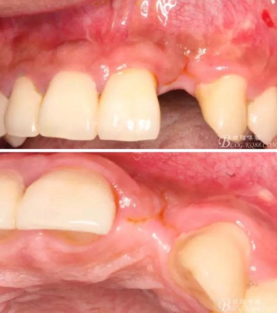 一例上前牙種植失敗病例的補(bǔ)救 一例上前牙種植失敗病例的補(bǔ)救
