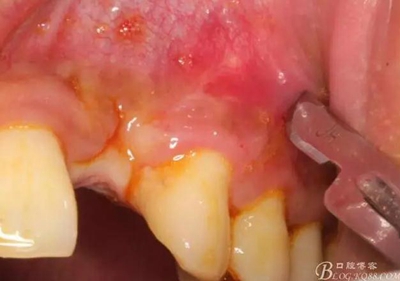一例上前牙種植失敗病例的補(bǔ)救 一例上前牙種植失敗病例的補(bǔ)救