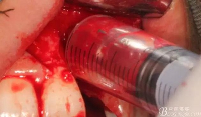 一例上前牙種植失敗病例的補(bǔ)救 一例上前牙種植失敗病例的補(bǔ)救