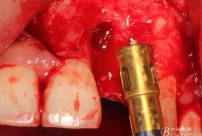 一例上前牙種植失敗病例的補(bǔ)救 一例上前牙種植失敗病例的補(bǔ)救